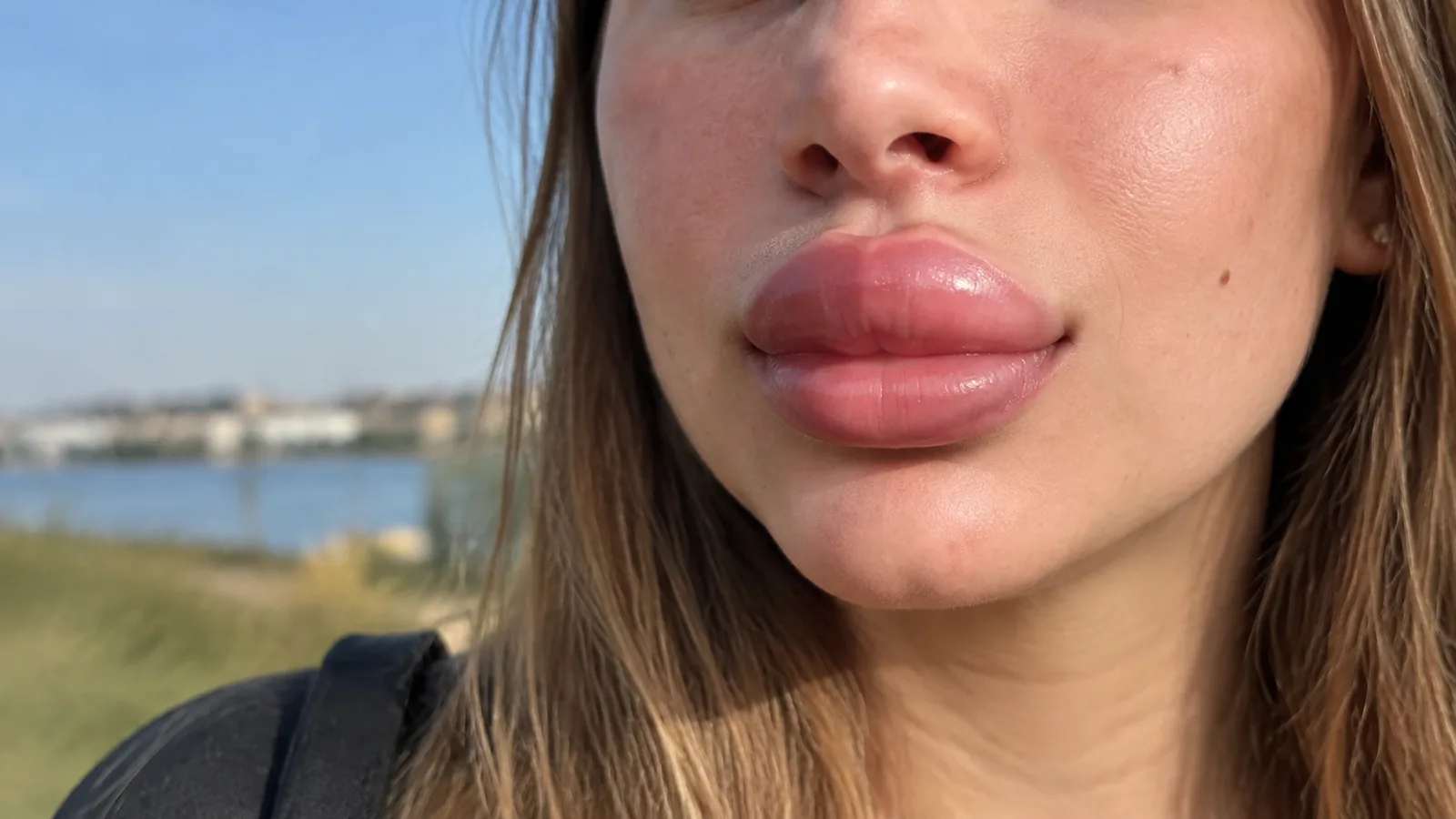 Levre qui gonfle : causes allergiques, urgence et gestes