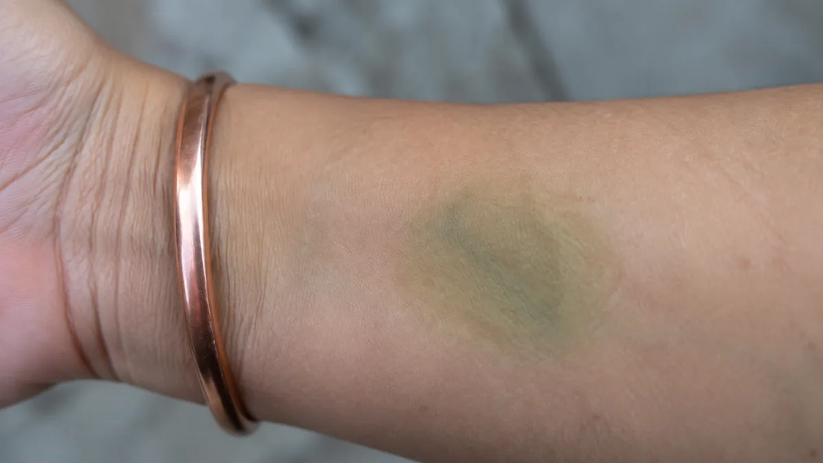Marque verte laissée par un bracelet en cuivre