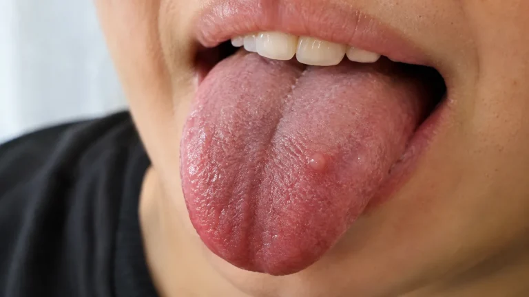 Petit bouton sur la langue qui pique : causes et que faire