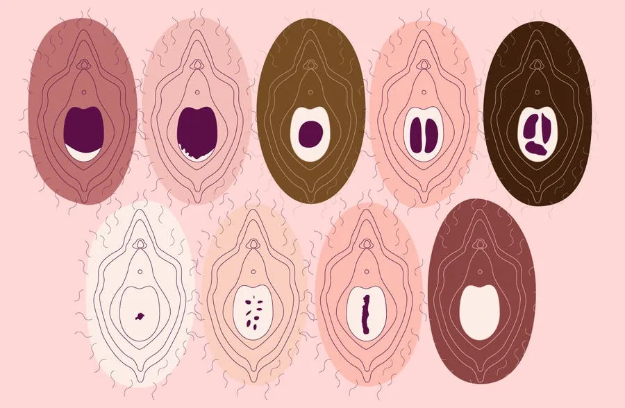 Différentes apparences de l'hymen et de l'ouverture vaginale