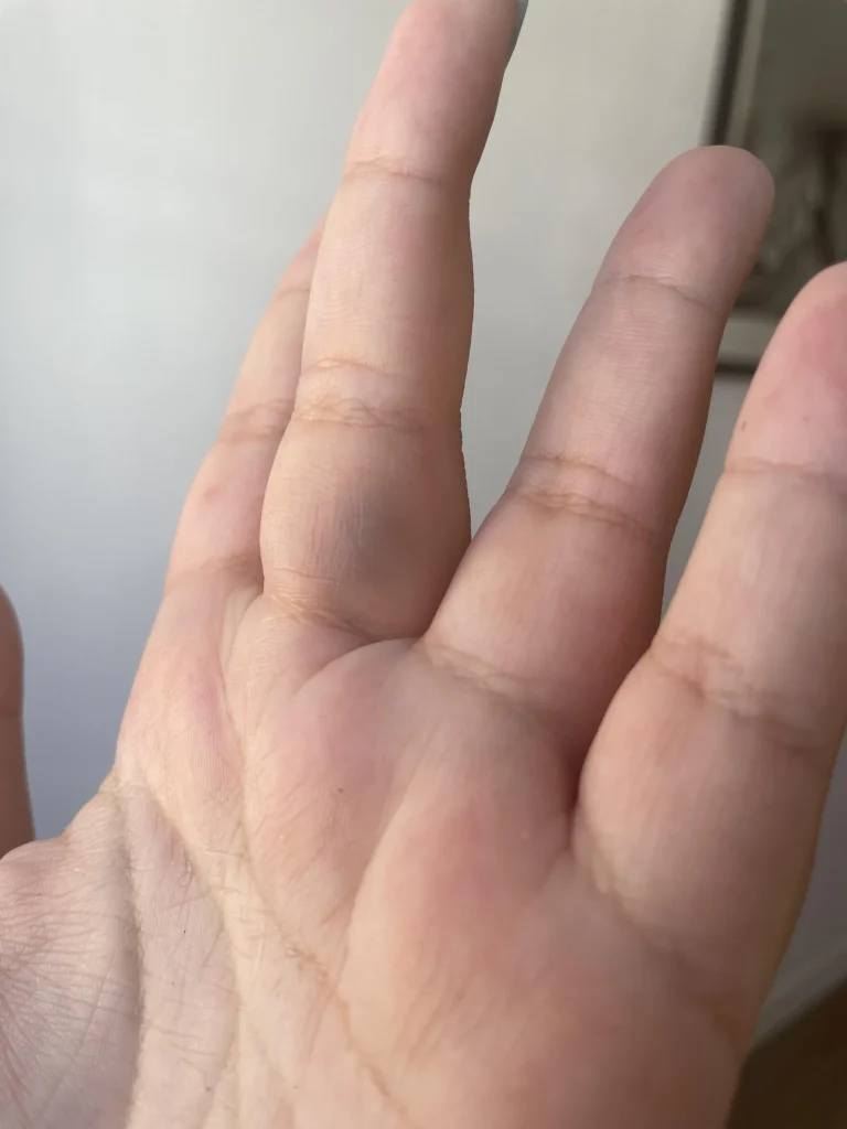 Vaisseaux des doigts qui éclatent : causes et conduite à tenir